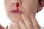 Chảy máu mũi có nguy hiểm không và phòng ngừa bệnh lý này bằng cách nào?
